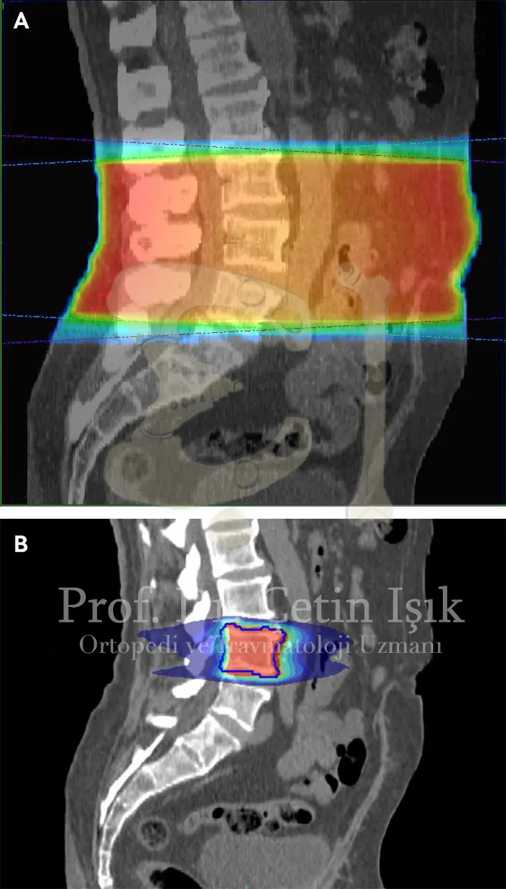Radiographs during treatment of spinal cancer located inside the vertebral bodies with radiation