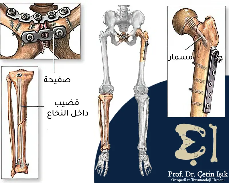 أنواع التثبيتات الداخلية للعظام من مسمار أو صفيحة أو قضيب