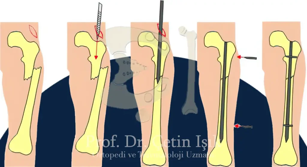 How to install the rod in bone internal fixation