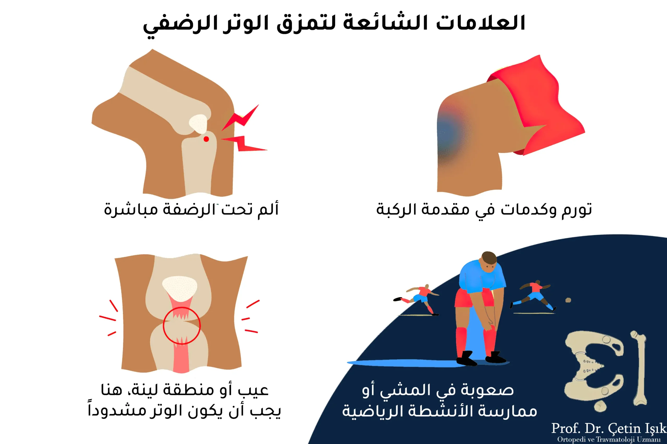 From the picture, we note the common symptoms when knee tendonitis occurs, which are swelling and bruising in the knee, knee pain, difficulty in exercising activities, and rupture of the inflamed tendon.