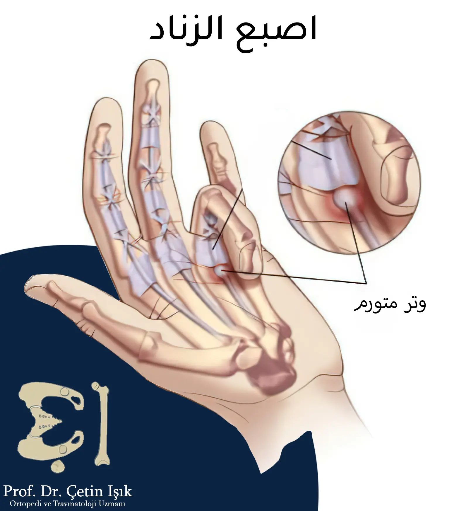 صورة تعبر عن حالة اصبع الزناد أو المقداح، وثبات الاصبع بوضعية الثني