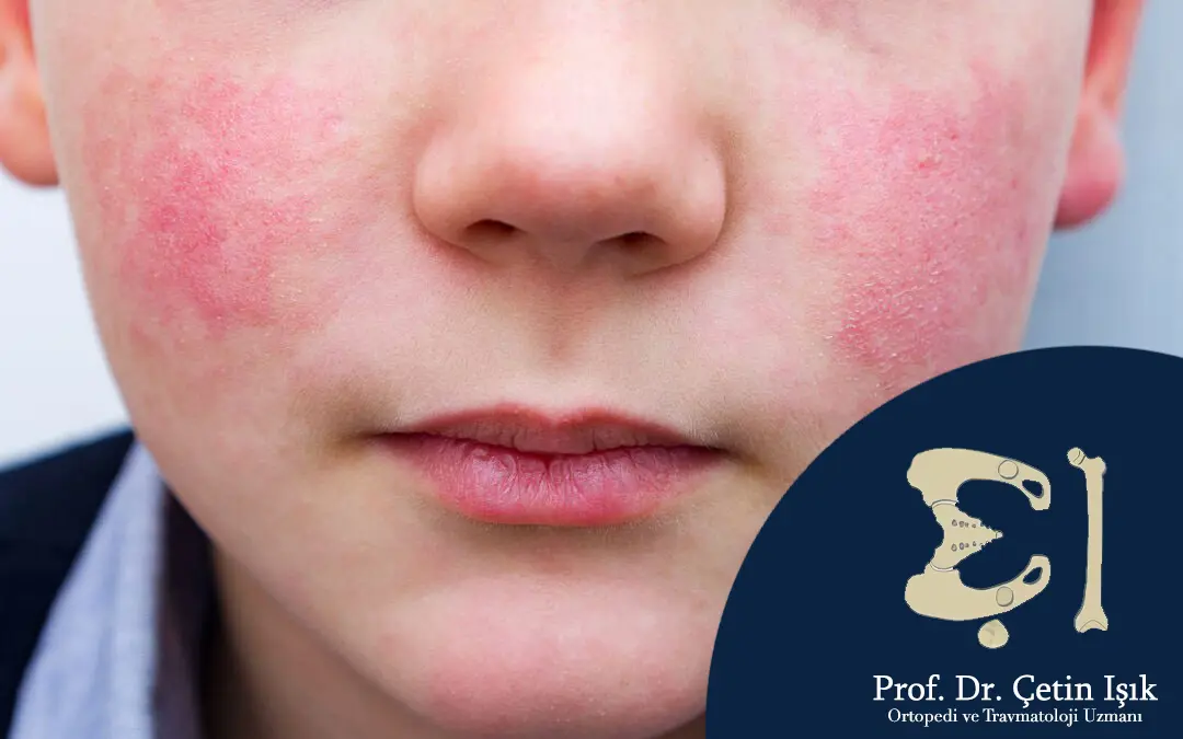 صورة توضح الطفح الجلدي والاحمرار الوجني لطفل مصاب بفيروس البارفوفيروس 19