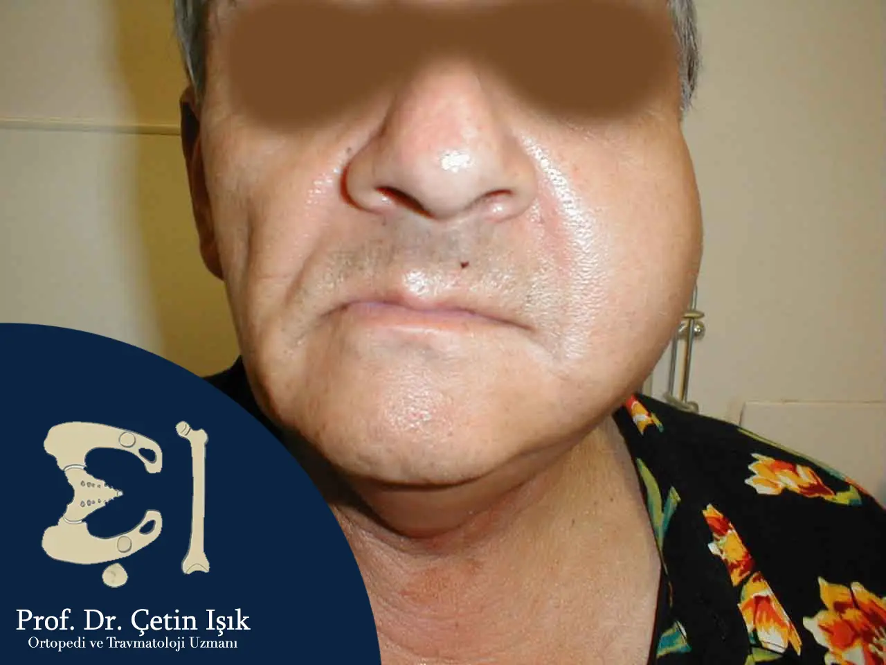 An image showing the enlargement of the parotid gland, which is detected by clinical examination and which follows infection with the mumps virus