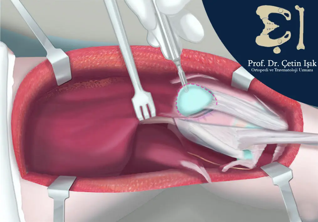 صورة توضح عملية تثبيت صابونة الركبة الجراحية، لعلاج الخلع المتكرر والناكس لصابونة الركبة