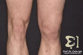 A picture of the lower limb of an adult man showing the difference between a normal right kneecap (left of the photo) and a dislocated left kneecap (right of the photo) that caused swelling in the knee joint