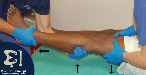 العلاج المحافظ لخلع صابونة الركبة عن طريق تمديد الساق ورد خلع صابونة الركبة بيد طبيب خبير