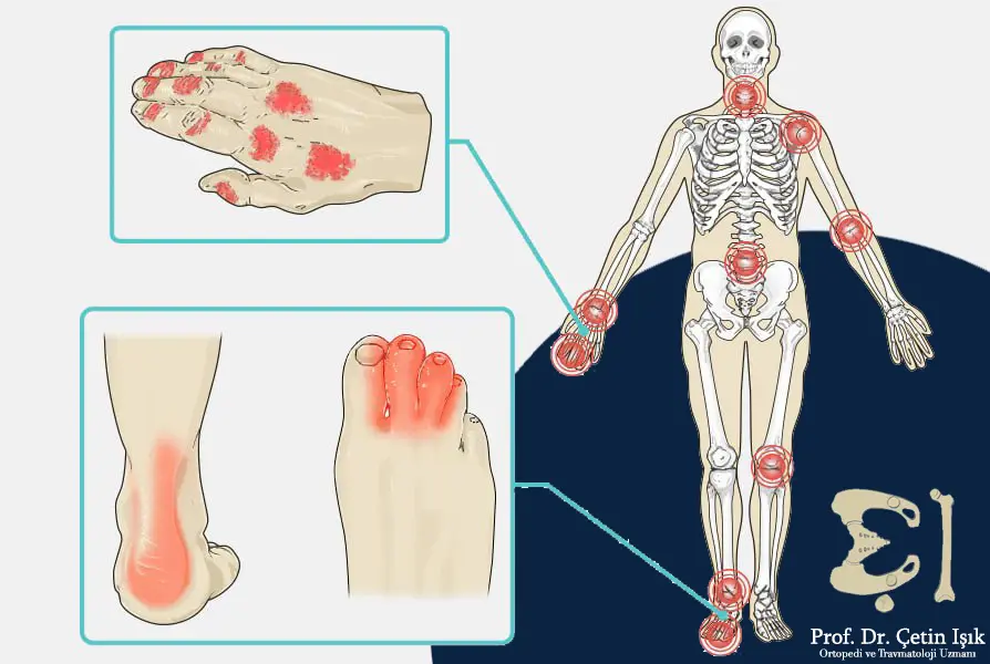 Image showing areas that can develop psoriatic arthritis