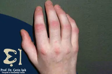 Photo of the hand of a person with psoriatic arthritis showing an asymmetrical pattern of injury, a condition called clubbing fingers