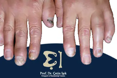 Image showing arthritis of the distal phalanx of the hand, in the context of psoriatic arthritis, with nail discoloration