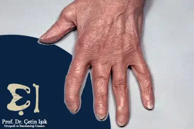 An image showing patterned psoriatic arthritis and deformity of the fingers 