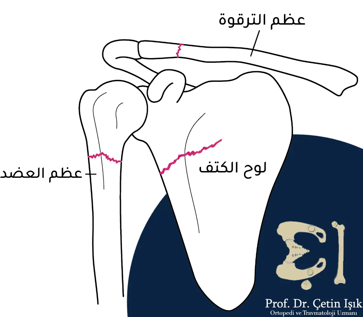 From the picture, we can see the types of shoulder fracture, which are the clavicle fracture, the scapula fracture, and the humerus fracture