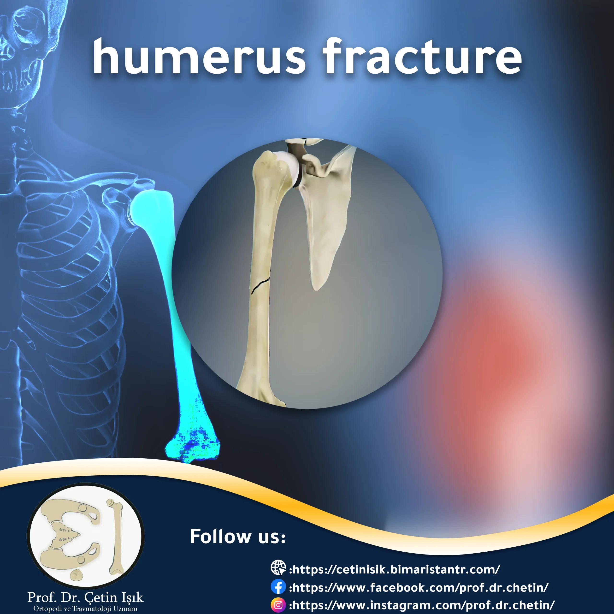 Humerus fracture; From diagnosis to treatment - Dr. What's wrong with you?