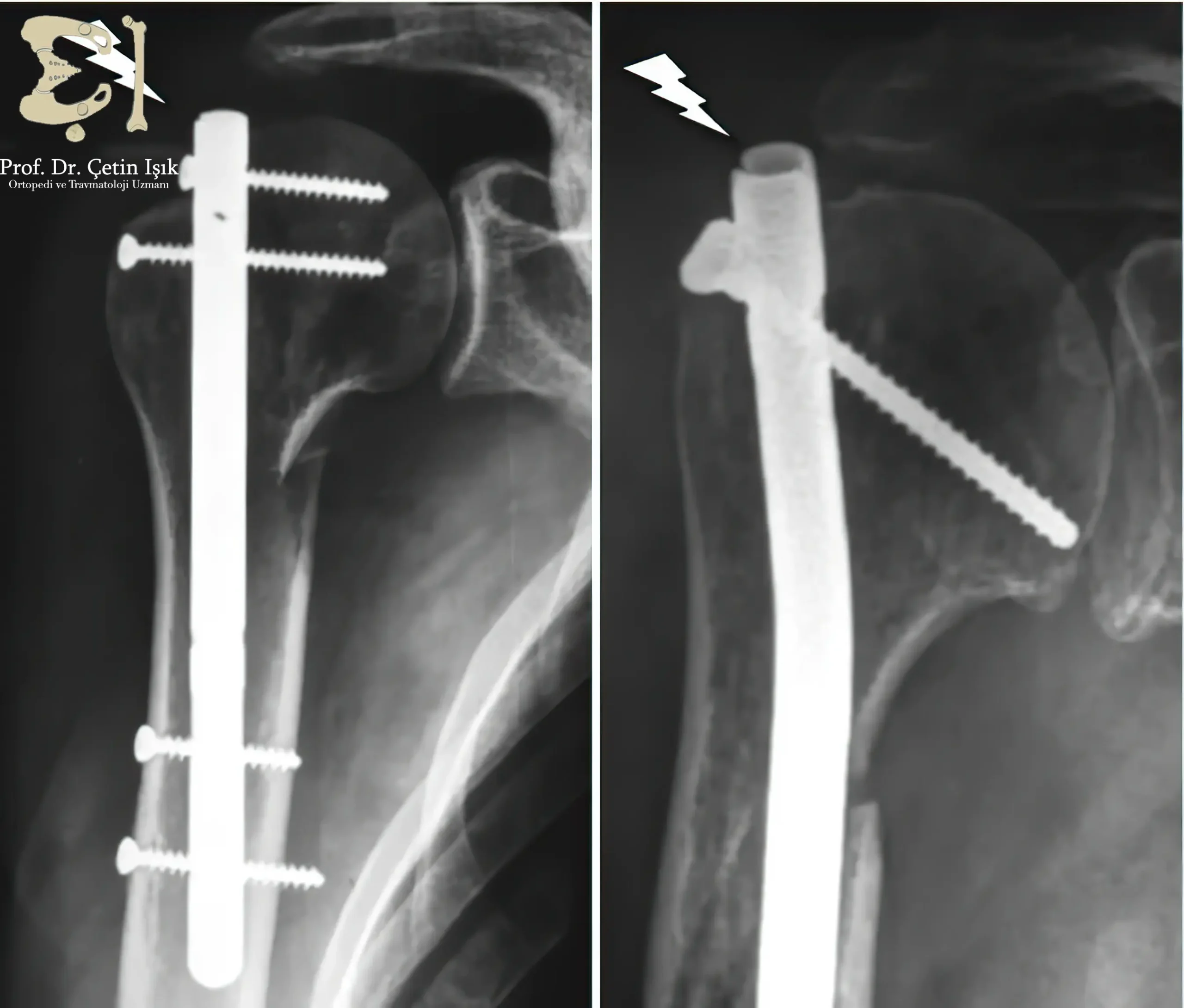 Image showing internal fixation to treat a humerus fracture using a metal skewer fixed with two screws from the top and bottom
