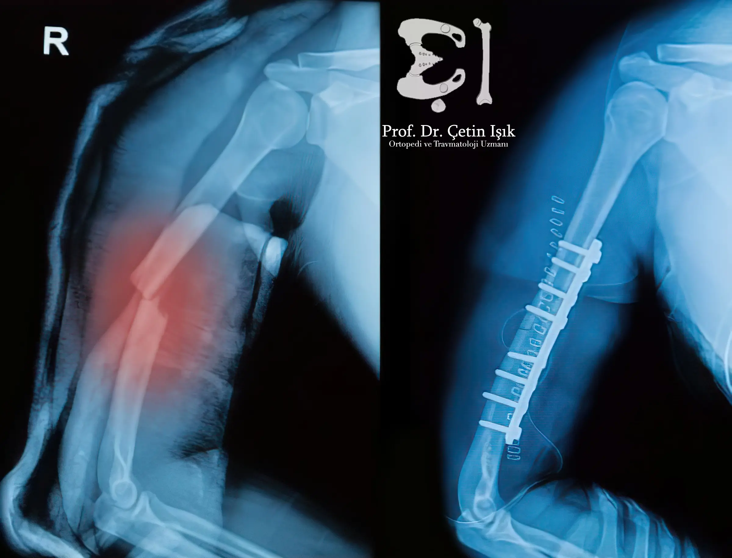 Image showing the internal fixation procedure for a humeral body fracture using plates and screws
