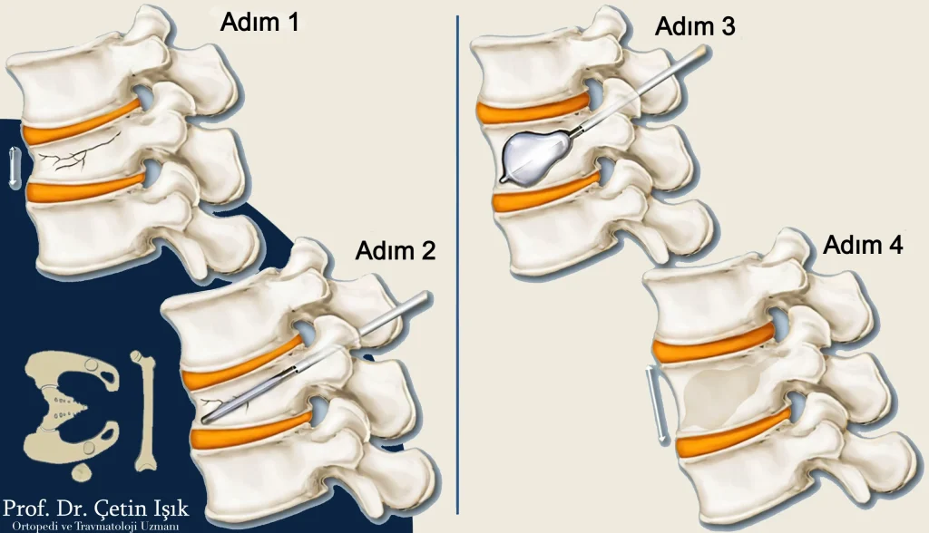 Vertebroplasty surgery steps to treat vertebrae fractures