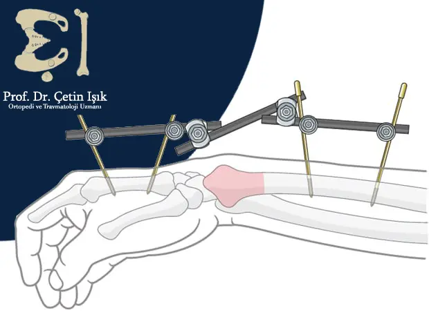 Image showing external fixation of a forearm fracture without passing through the fracture focus