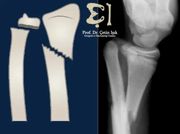 Image showing a Galliazi fracture, in which the radius is fractured, and the ulnar-radial joint is dislocated