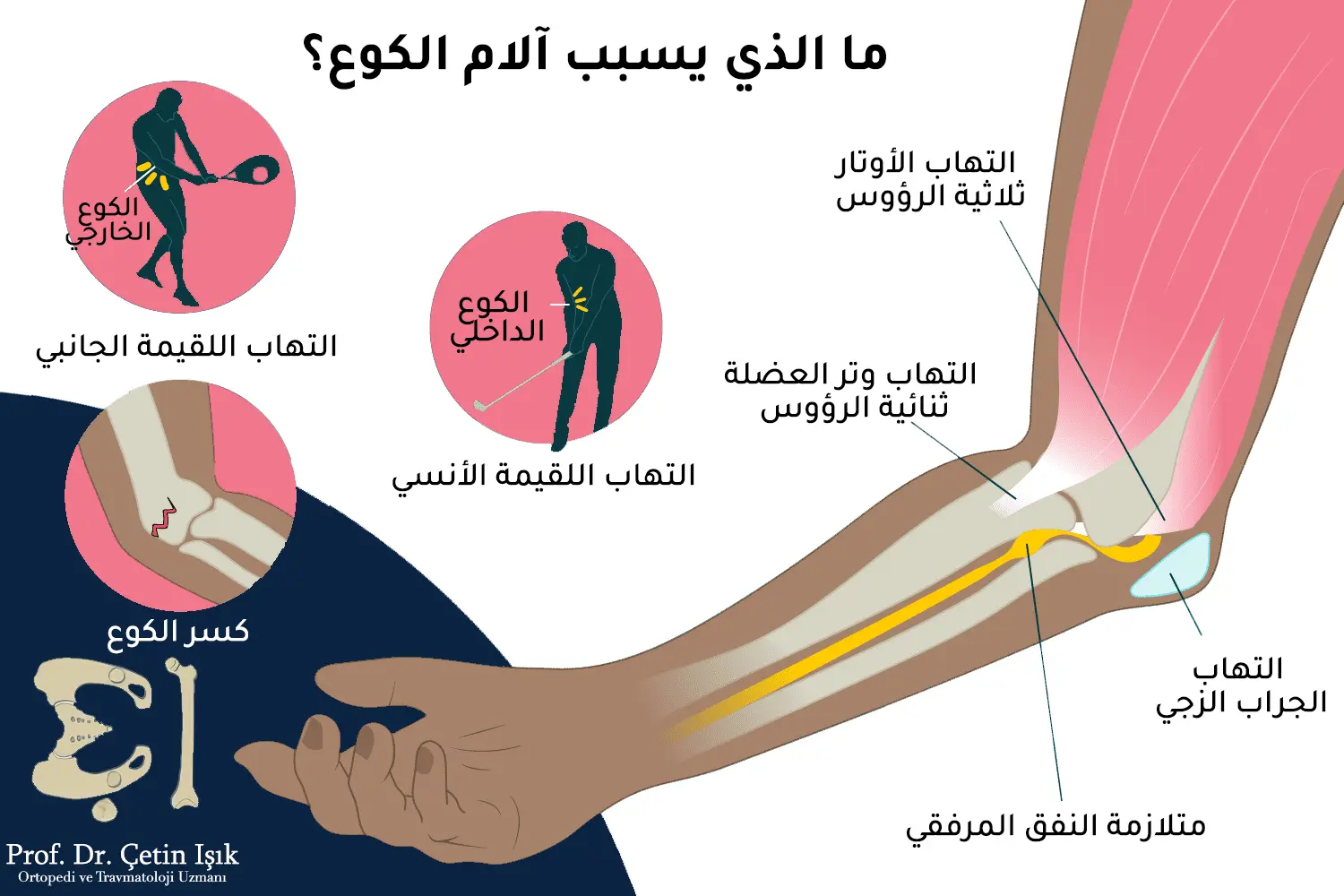 نلاحظ من الصورة أهم اسباب الألم في مفصل الكوع وهي التهاب الجراب الزجي، التهاب أوتار العضلة ثلاثية أو ثنائية الرؤوس، التهاب اللقيمة الأنسي، متلازمة النفق المرفقي وكسر الكوع