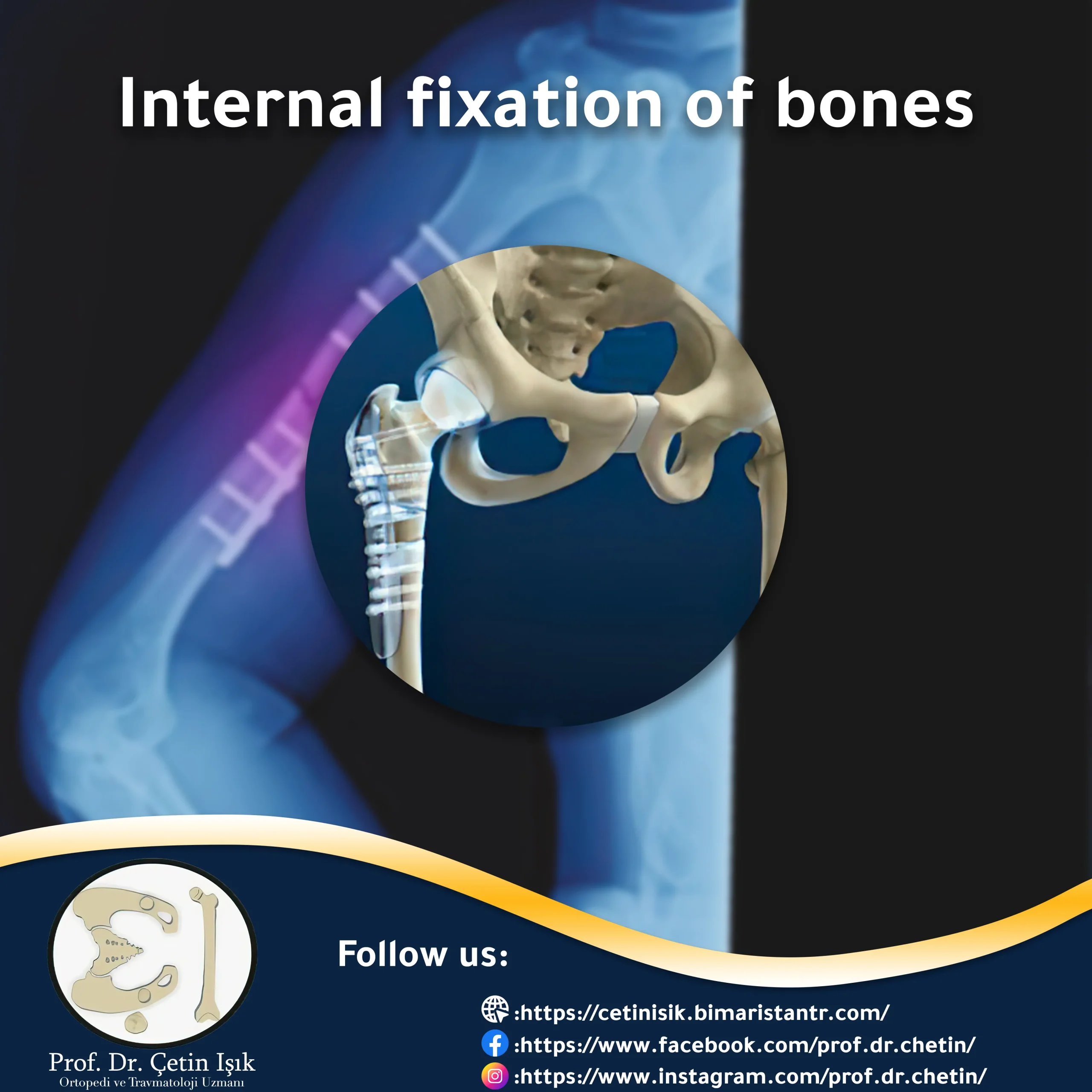 Internal fixation of bones to treat fractures