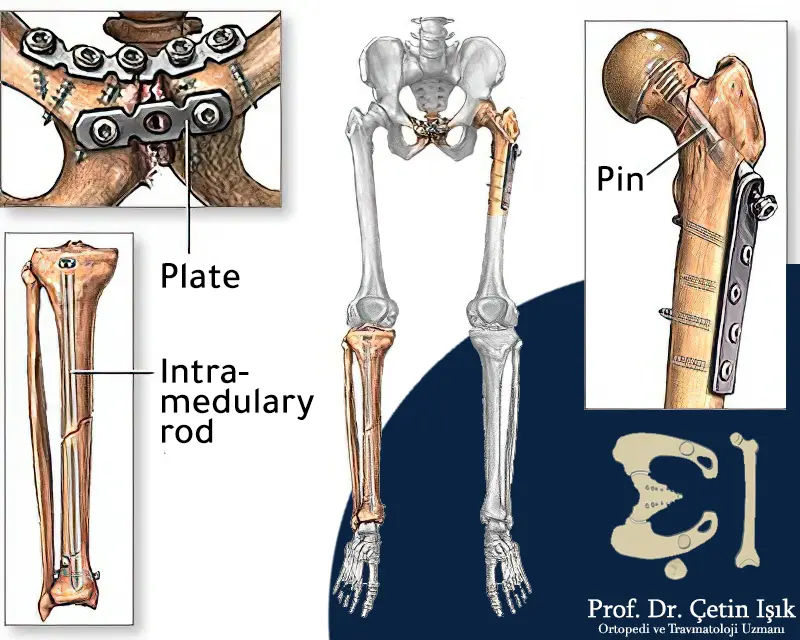 Types of internal bone fixations such as a nail, plate or rod