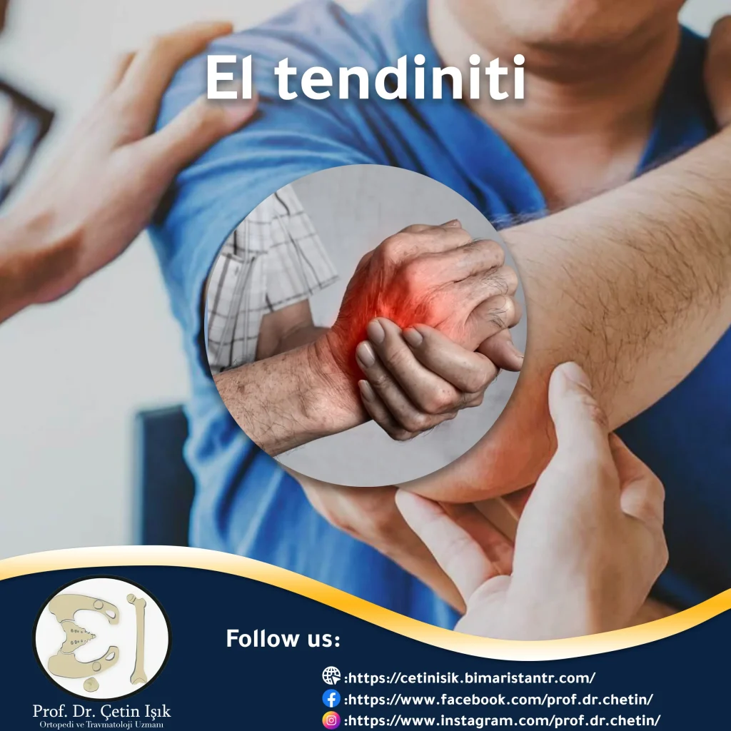 Cover image of the hand tendinitis article