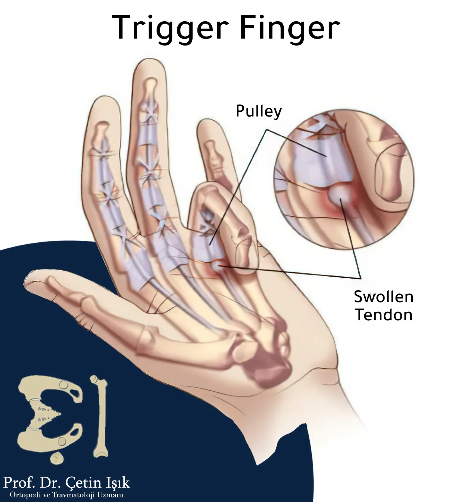 An image expressing the state of the trigger finger or the firing pin, and the stability of the finger in the bent position