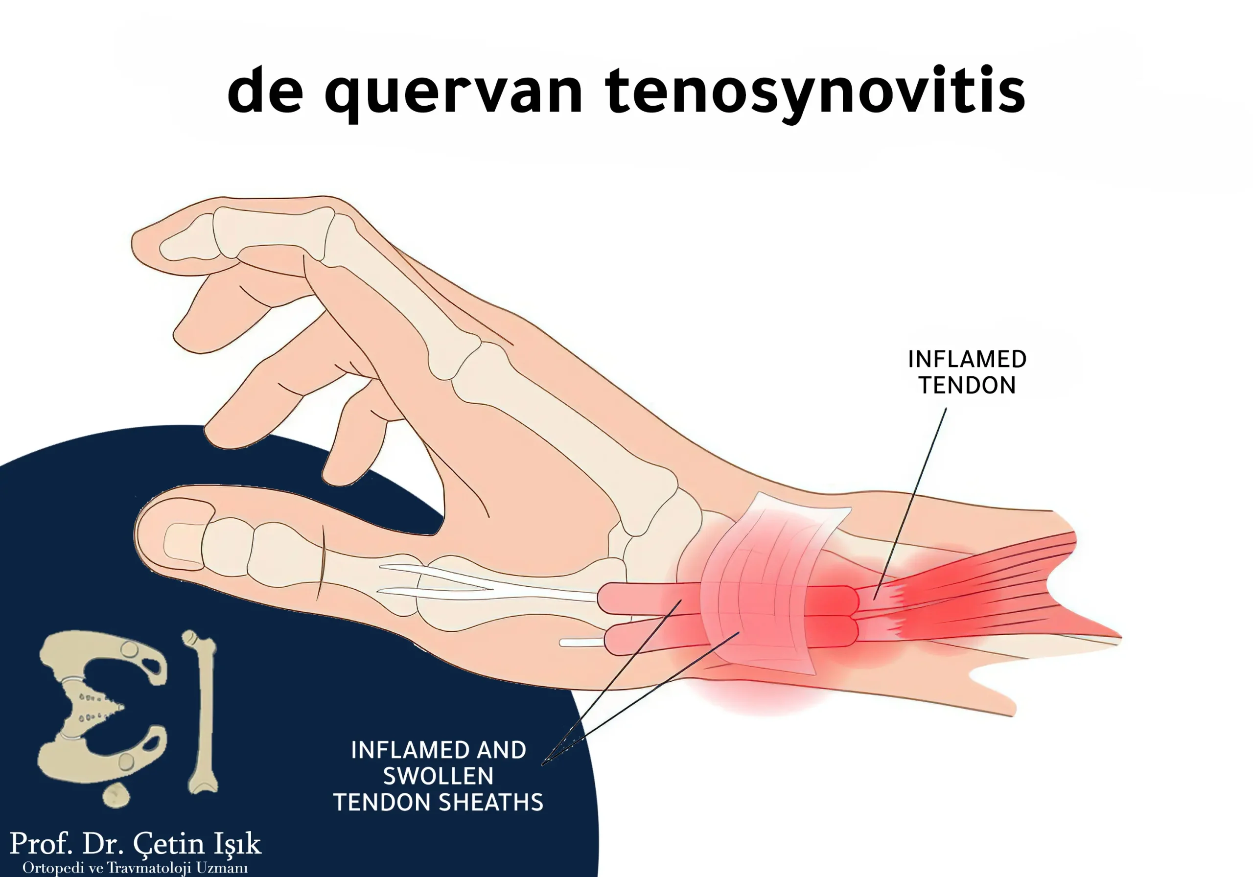 Image showing the location and location of de Quervain's tendon inflammation