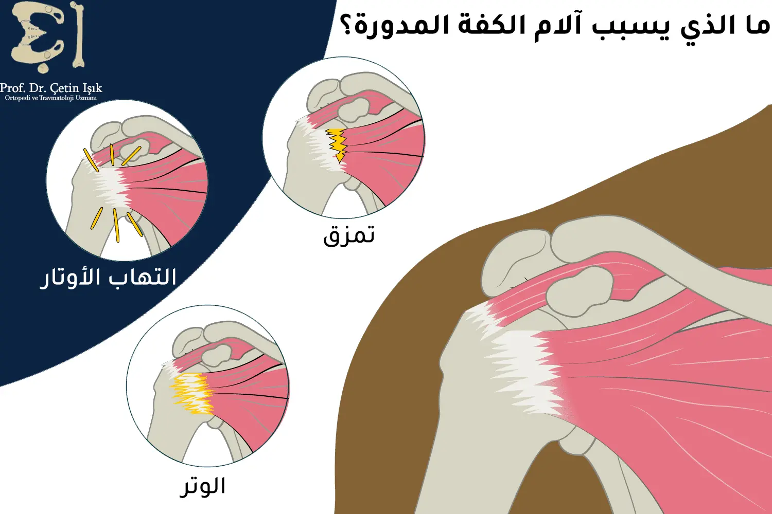 Rotator cuff inflammation methods of diagnosis and treatment Dr. What's wrong with you?