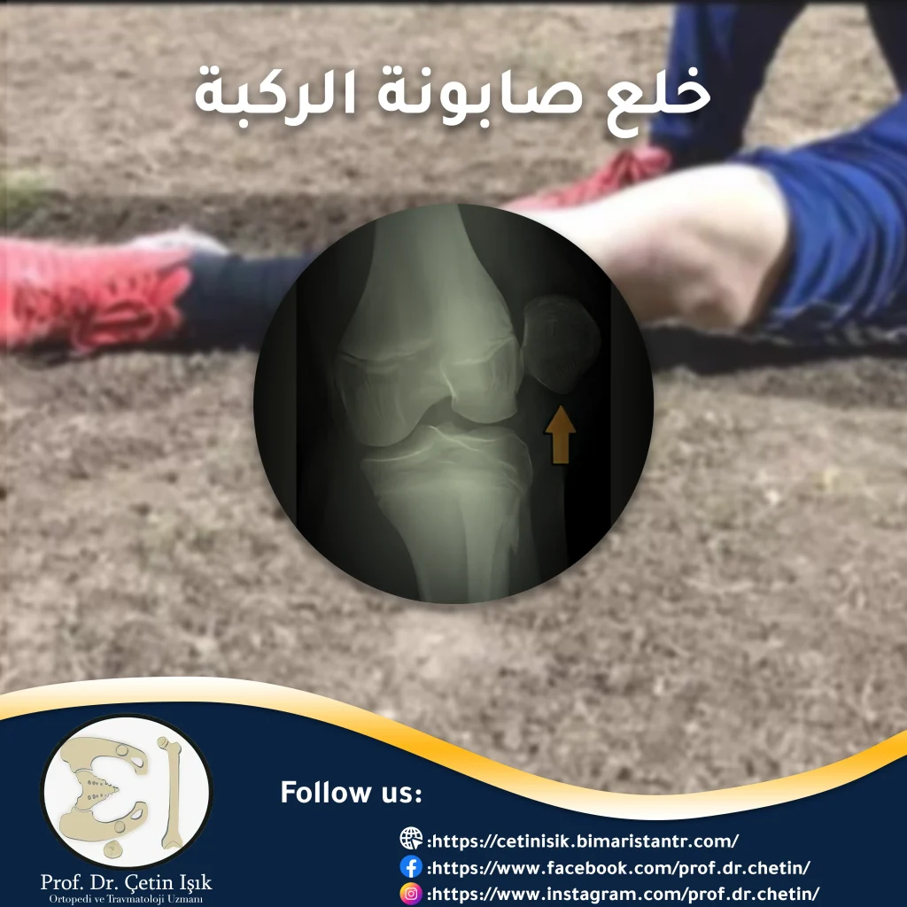 Cover image showing kneecap dislocation
