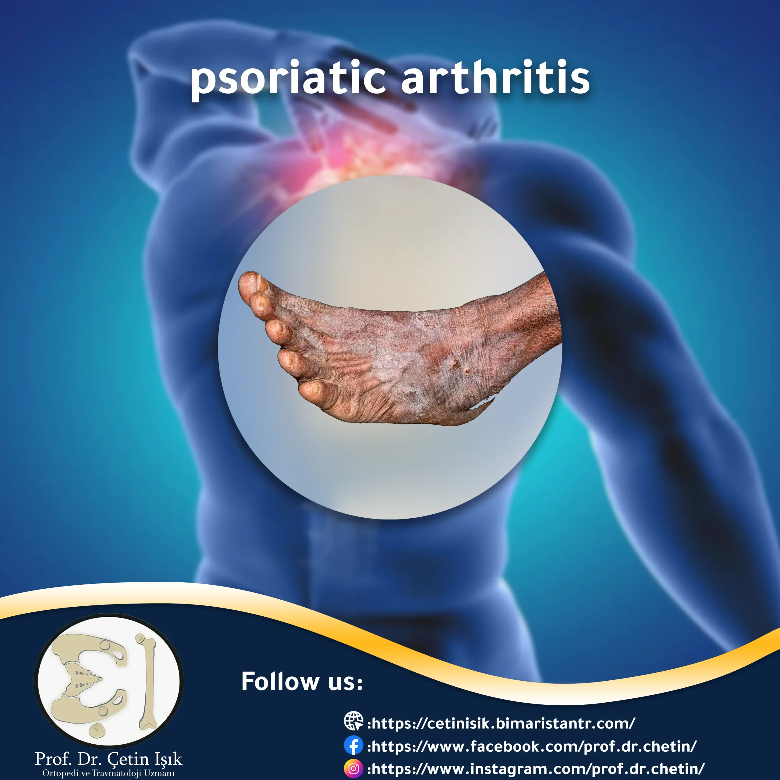 Cover image of the psoriasis article