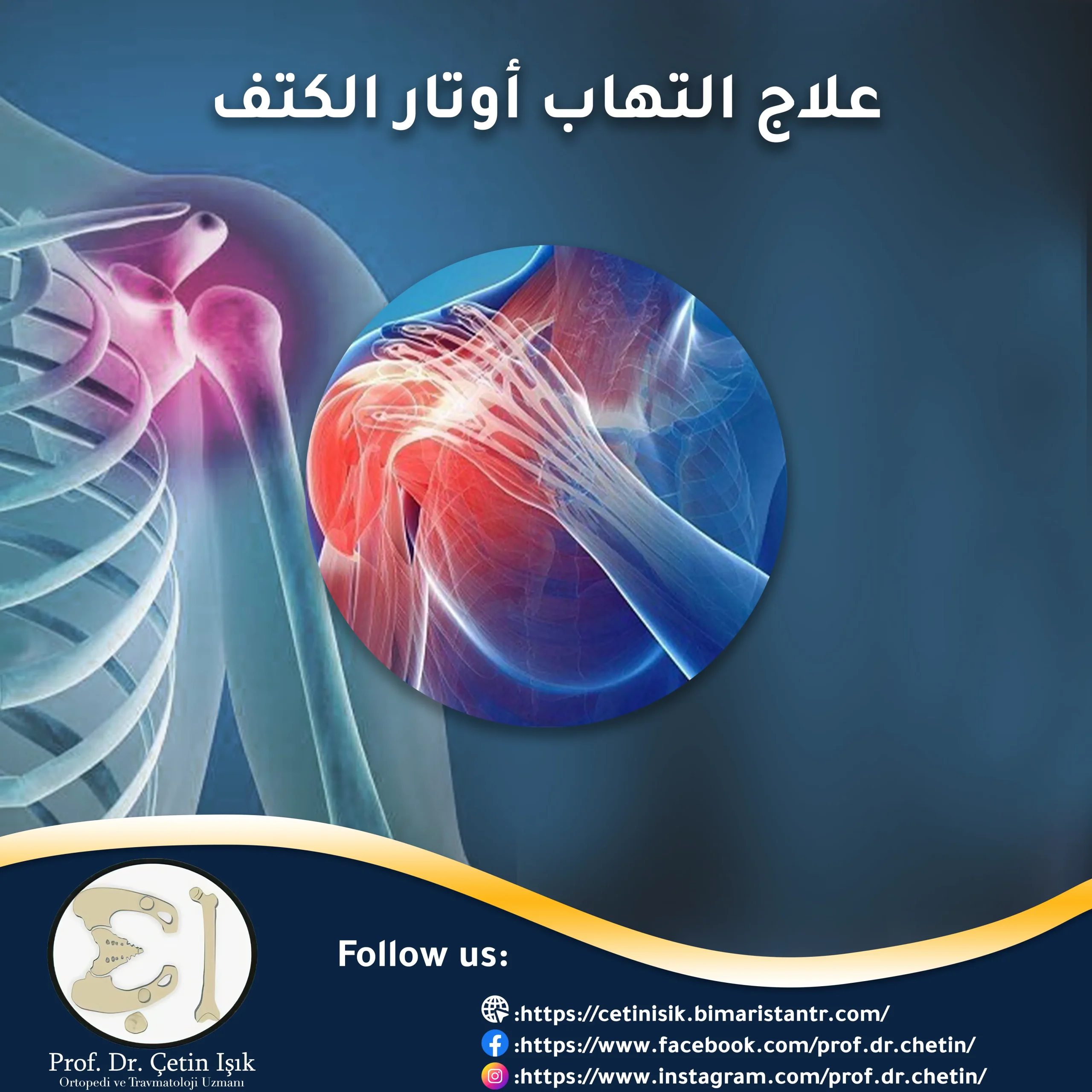 علاج التهاب أوتار الكتف والتخلص من الألم