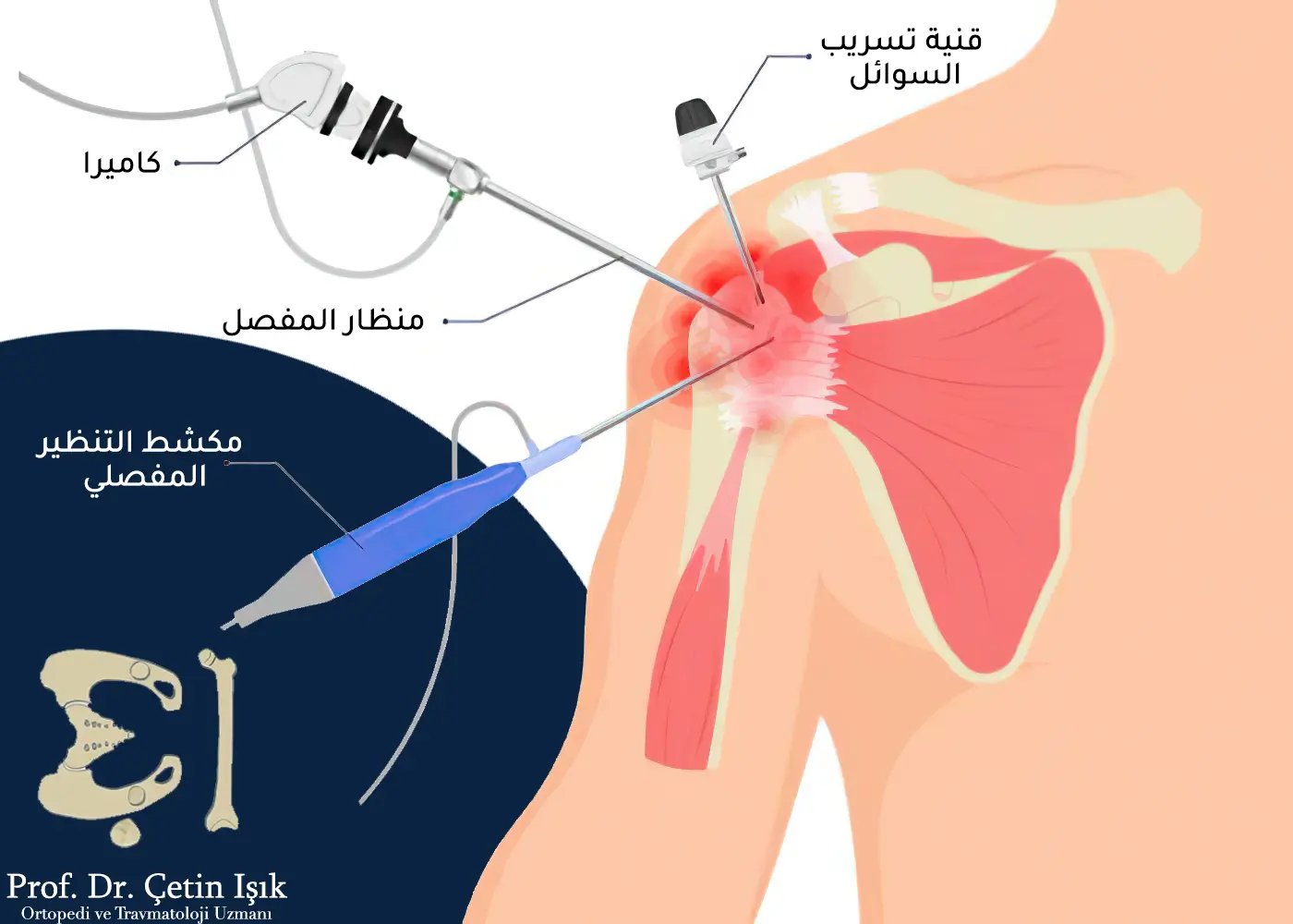 علاج التهاب أوتار الكتف والتخلص من الألم د شتين اشيك 5250