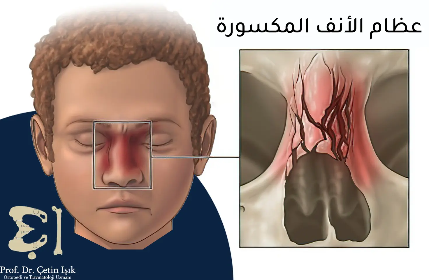 صورة توضح حدوث كسور في عظام الأنف حيث نلاحظ تأثر الجزء العلوي (العظمي) للأنف