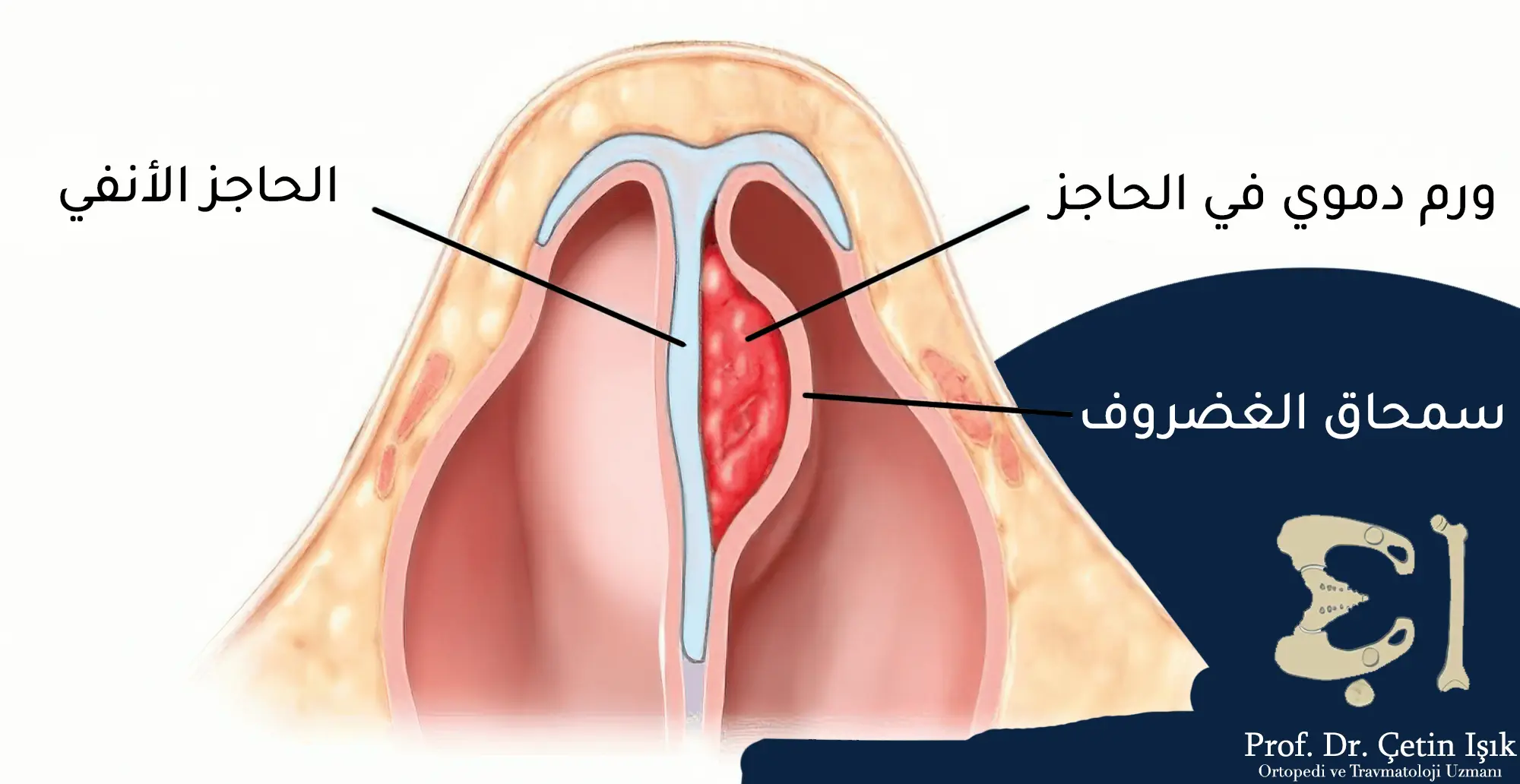 An image showing the formation of a hematoma on the nasal septum and its pressure on the cartilage beneath it