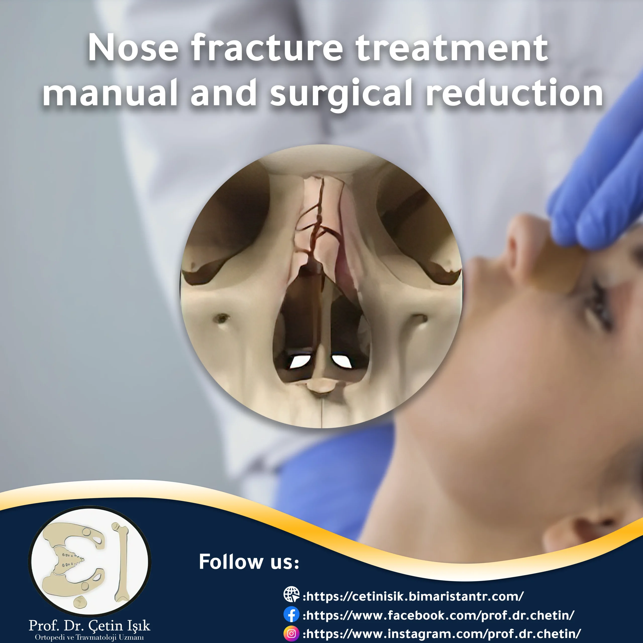 Nose fracture treatment: manual and surgical reduction