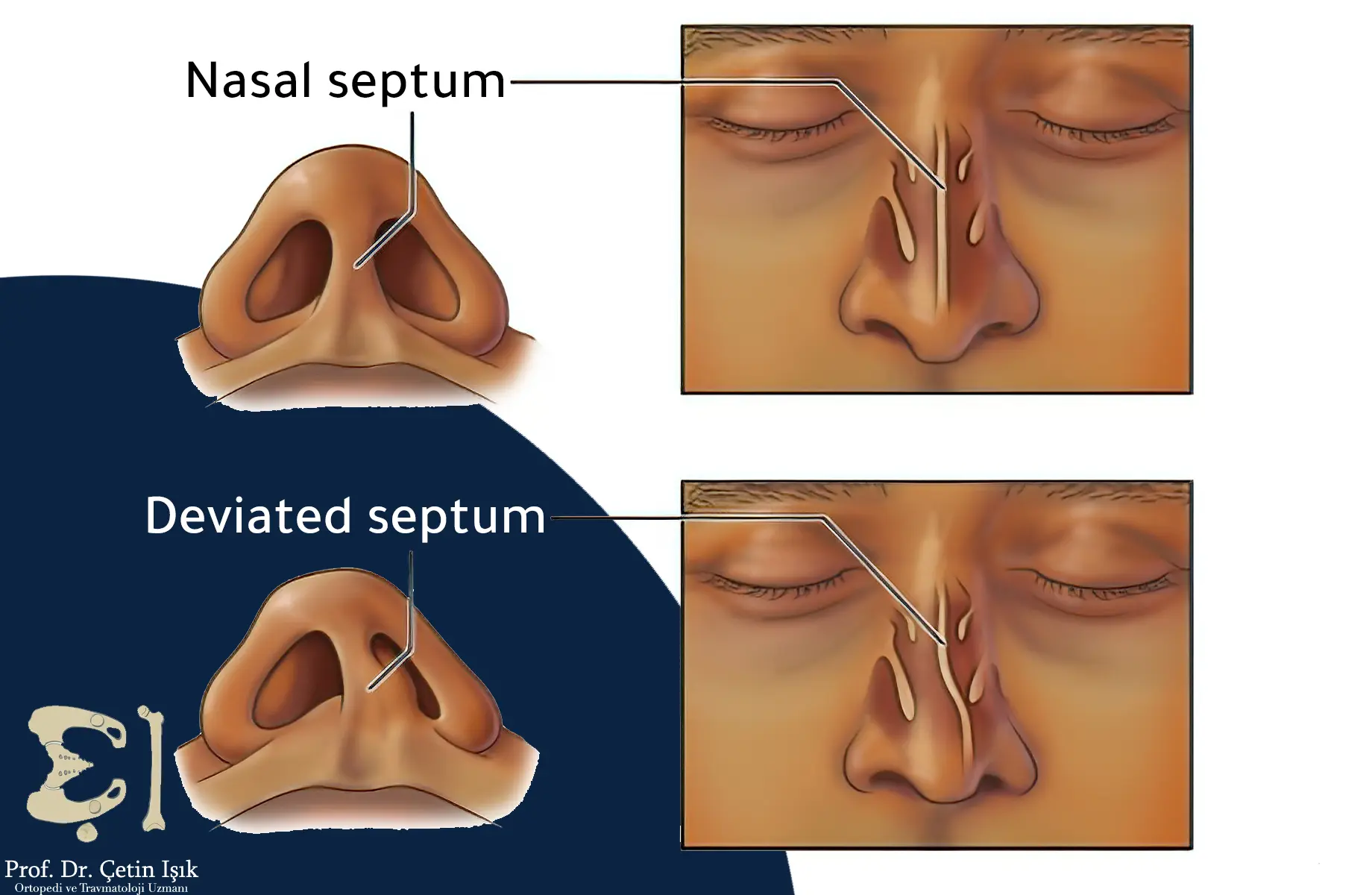 Image showing the deviation of the nasal septum from the midline