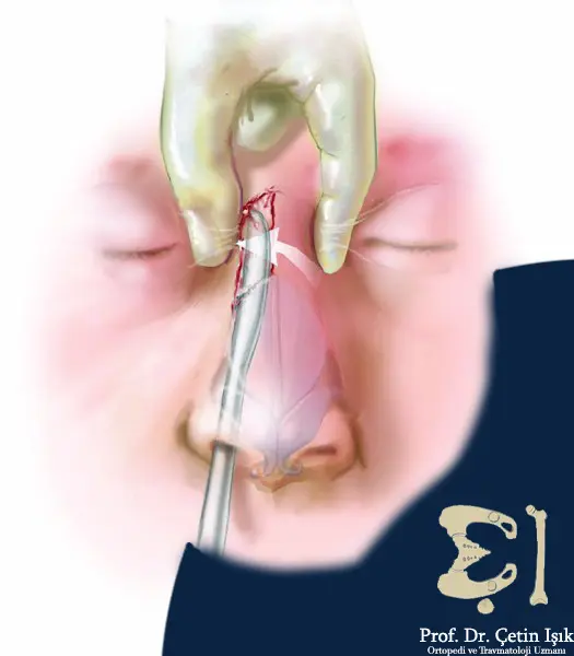 Image showing the mechanism of manual (closed) response to a nasal fracture, by inserting the lever tool into the nasal cavity at the affected end, and then straightening the fracture