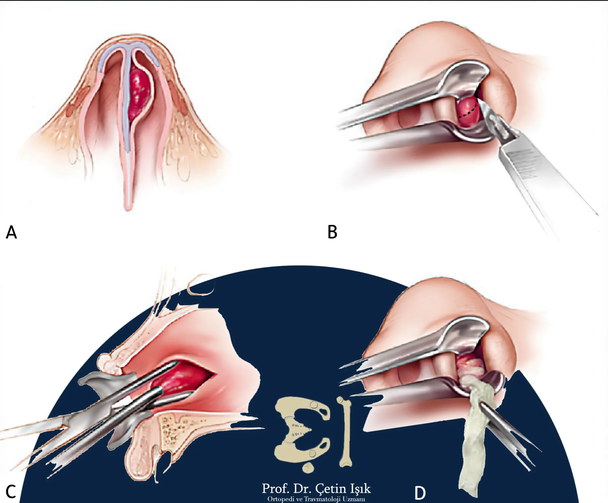 An image showing the method of treating the hematoma formed on the nasal septum, by making a simple incision for the tumor and draining the blood, and then suturing it to ensure that it does not re-form