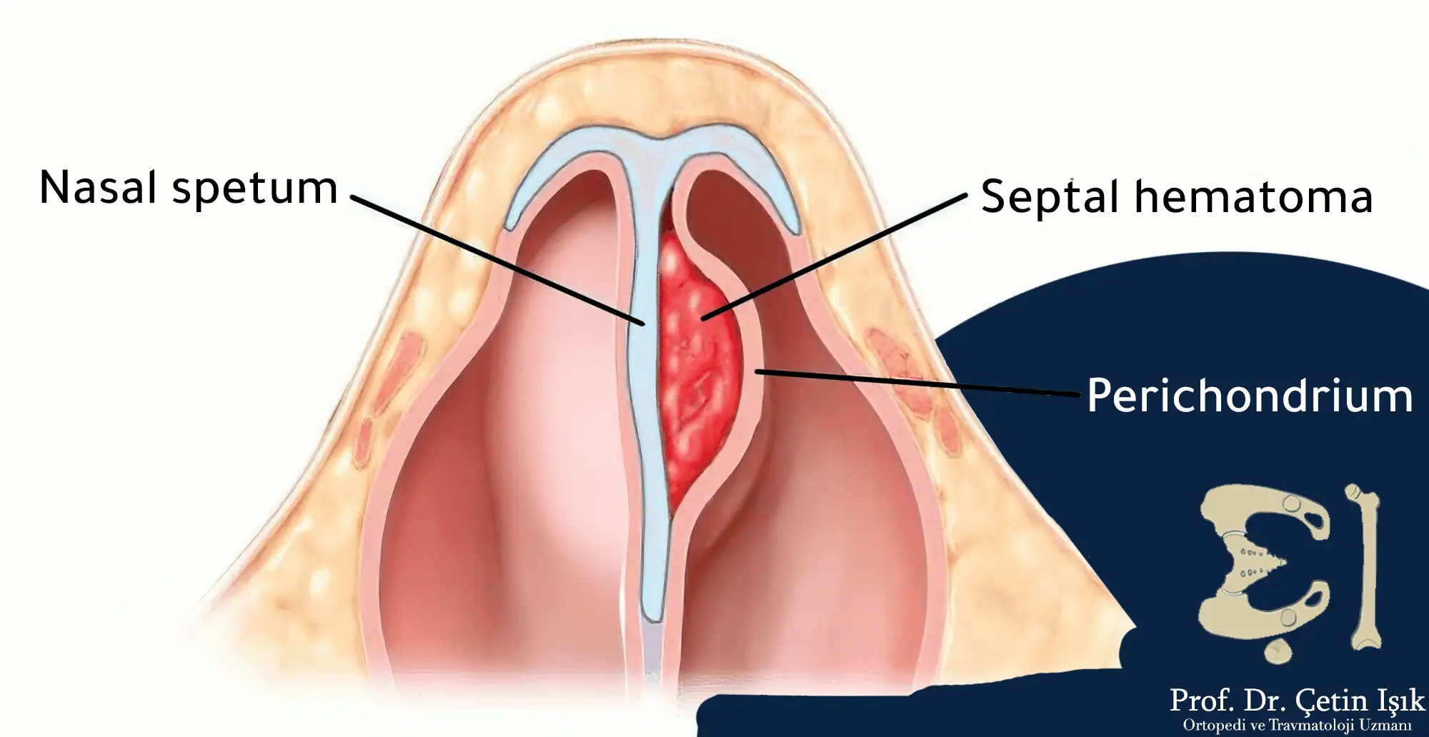 An image showing the formation of a hematoma on the nasal septum and its pressure on the cartilage beneath it