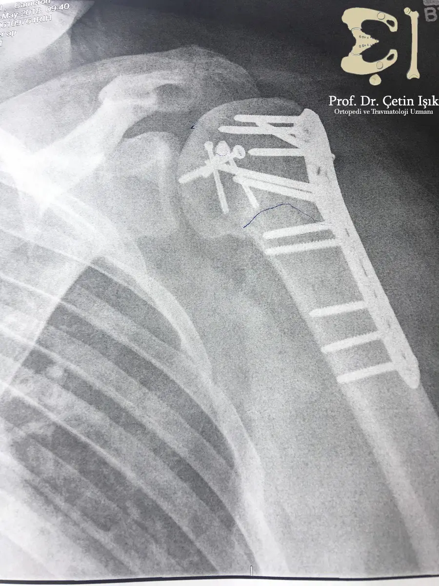 Shoulder fracture treatment the joint returns to normal Dr. What's