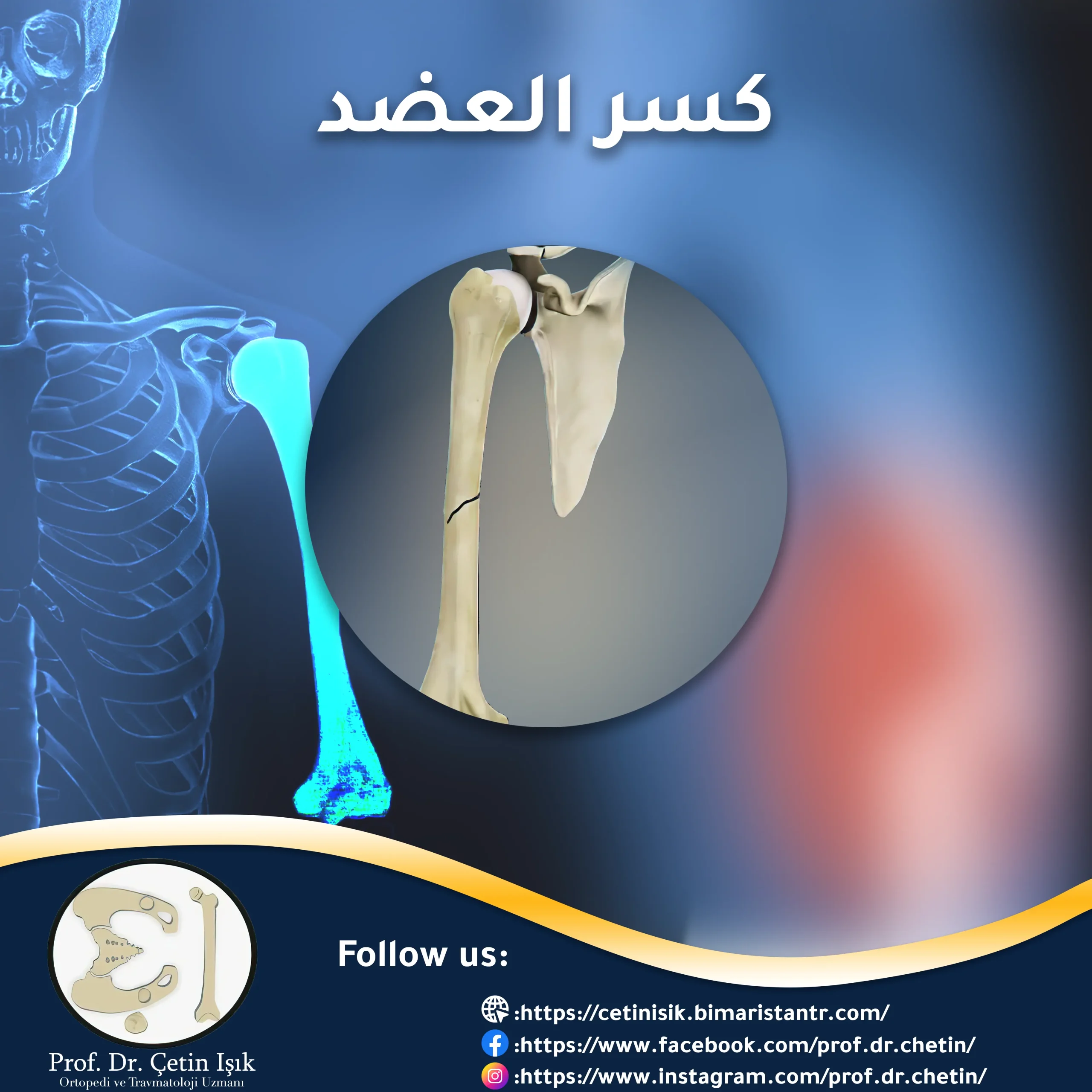 كسر العضد؛ من التشخيص إلى العلاج