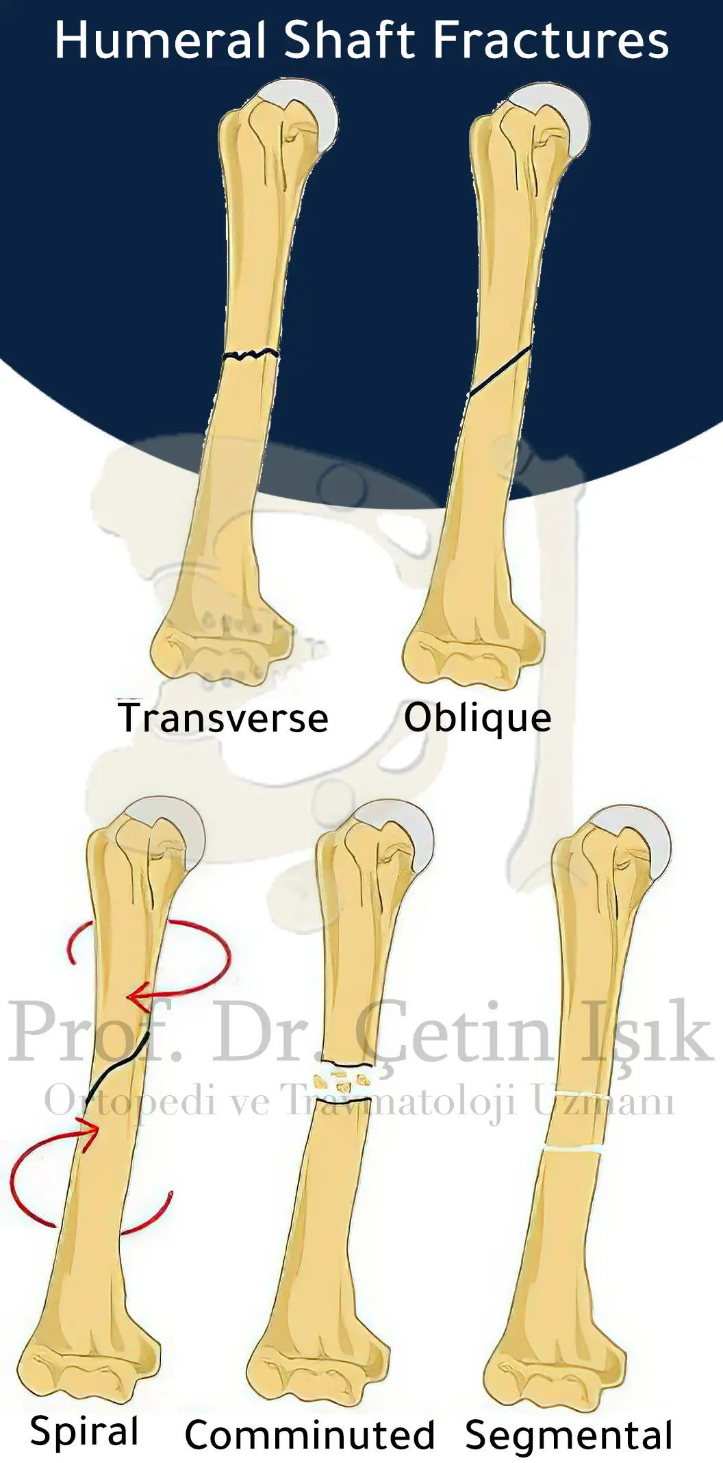 Image showing the different types of humerus fracture
