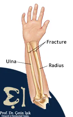 Image showing the bones that make up the forearm, namely the ulna (left of the image) and the radius (right of the image)