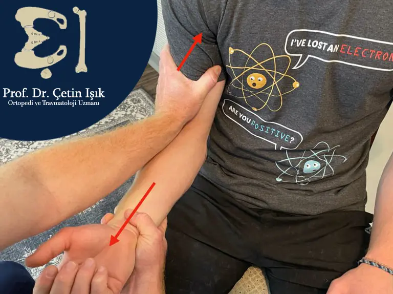 Image illustrating the elbow dislocation reflex mechanism