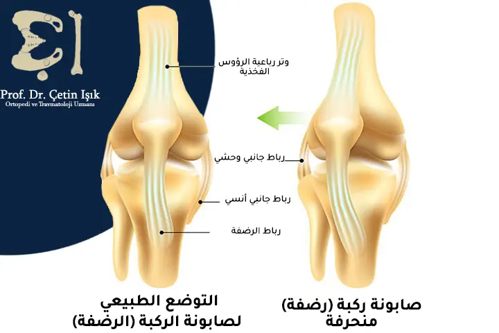 صورة توضح مقارنة بين وضع صابونة الركبة الطبيعي وحالة خلع صابونة الركبة