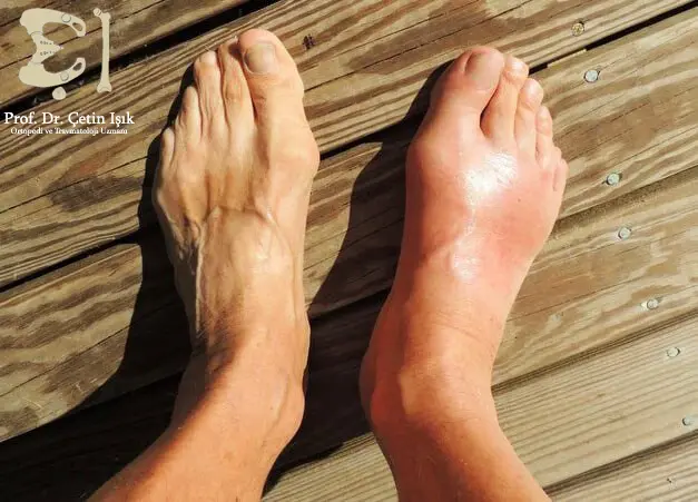 A picture showing swelling in the right foot after exposure to a trauma that caused a fracture