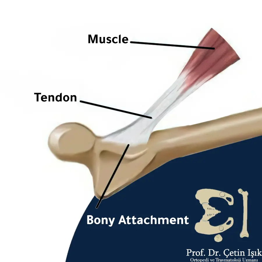 We notice in the picture that the muscle's tendon is anchored to the bone by the bony anchor.