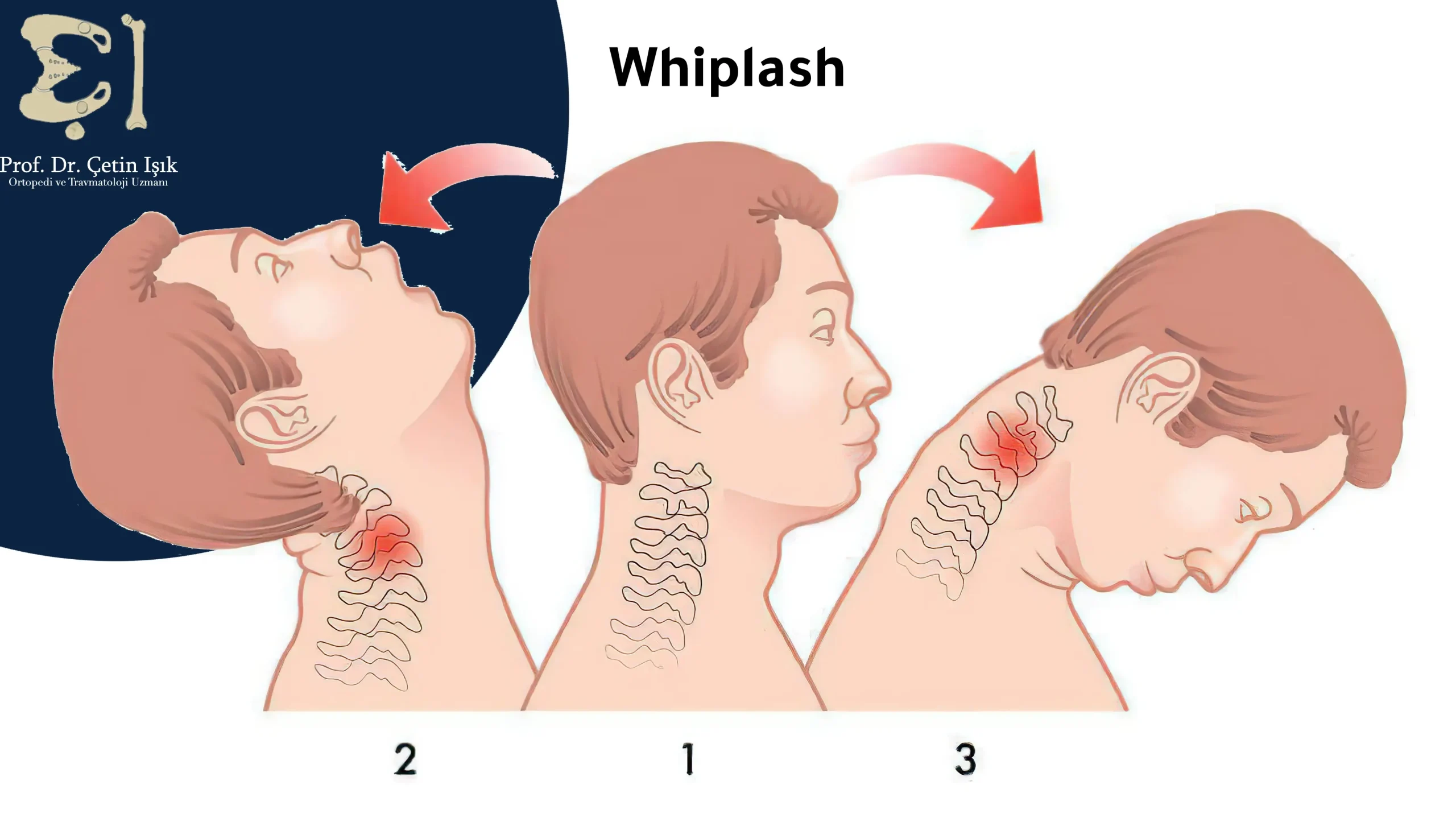 A picture showing the occurrence of neck twisting (whiplash) in the patient, with hyperextension (backward) and hyperflexion (forward)