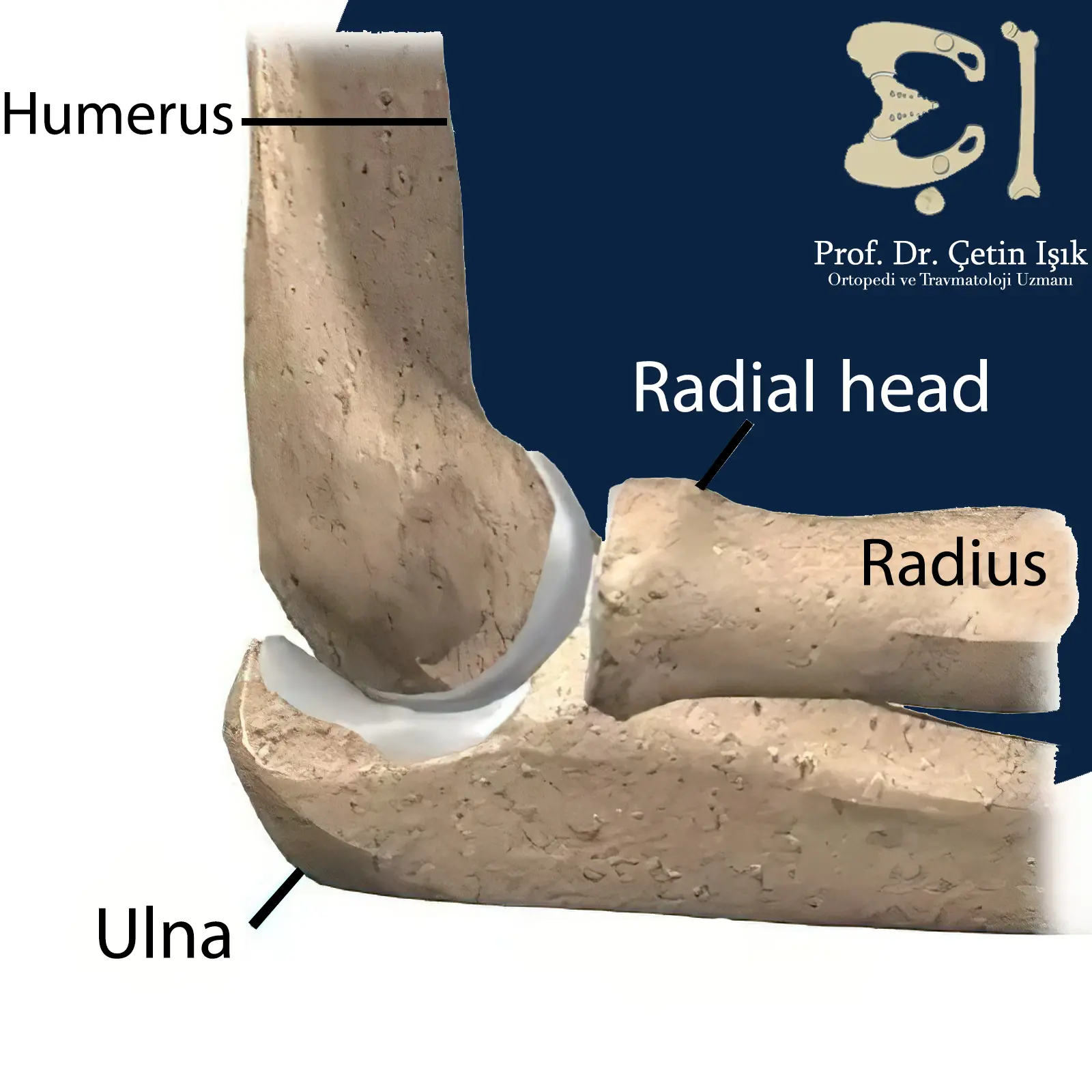 An image showing the components of the elbow joint and the bones that make up this joint