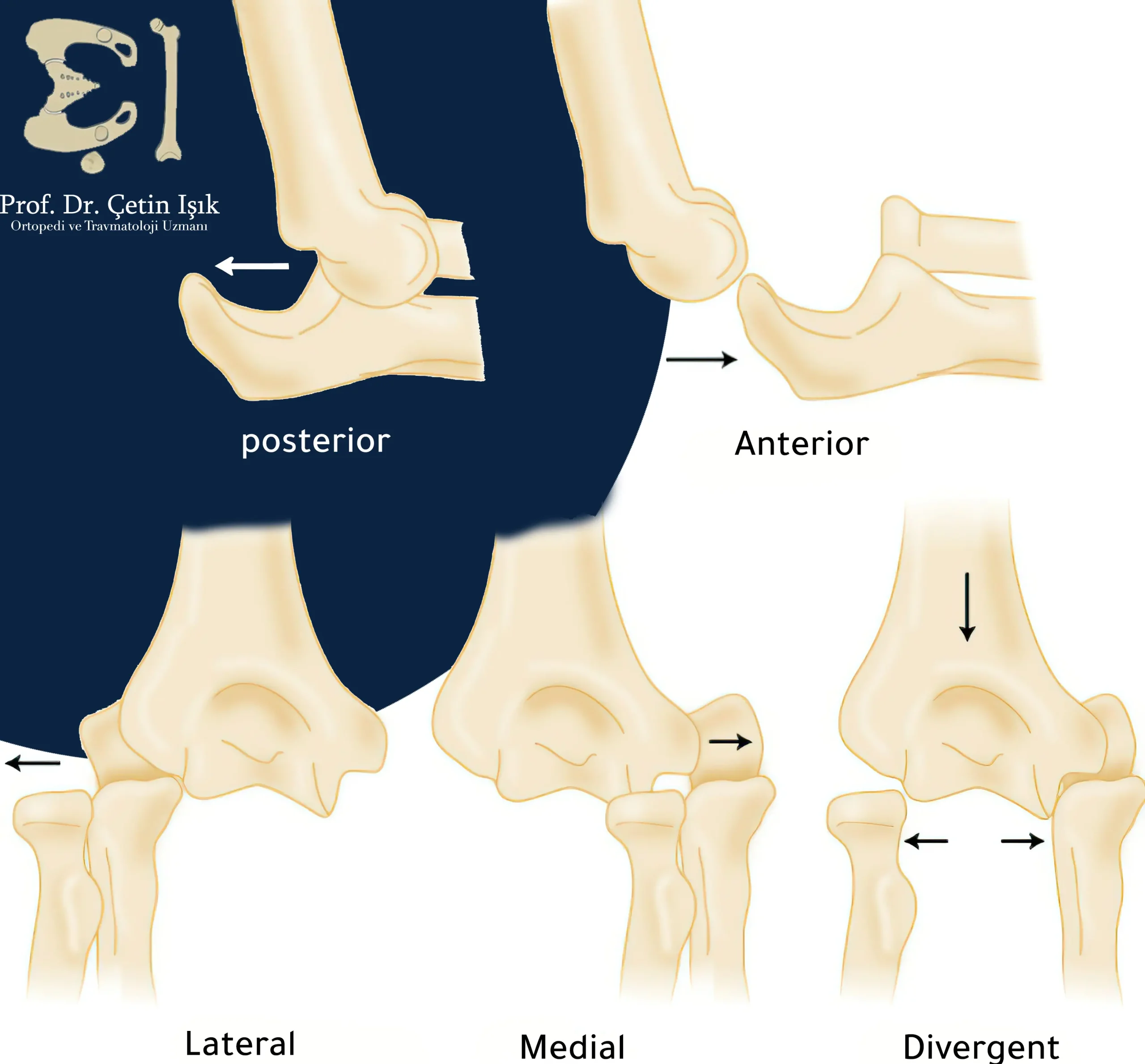 An image showing the different types of dislocation of the elbow joint, depending on the location of the dislocation